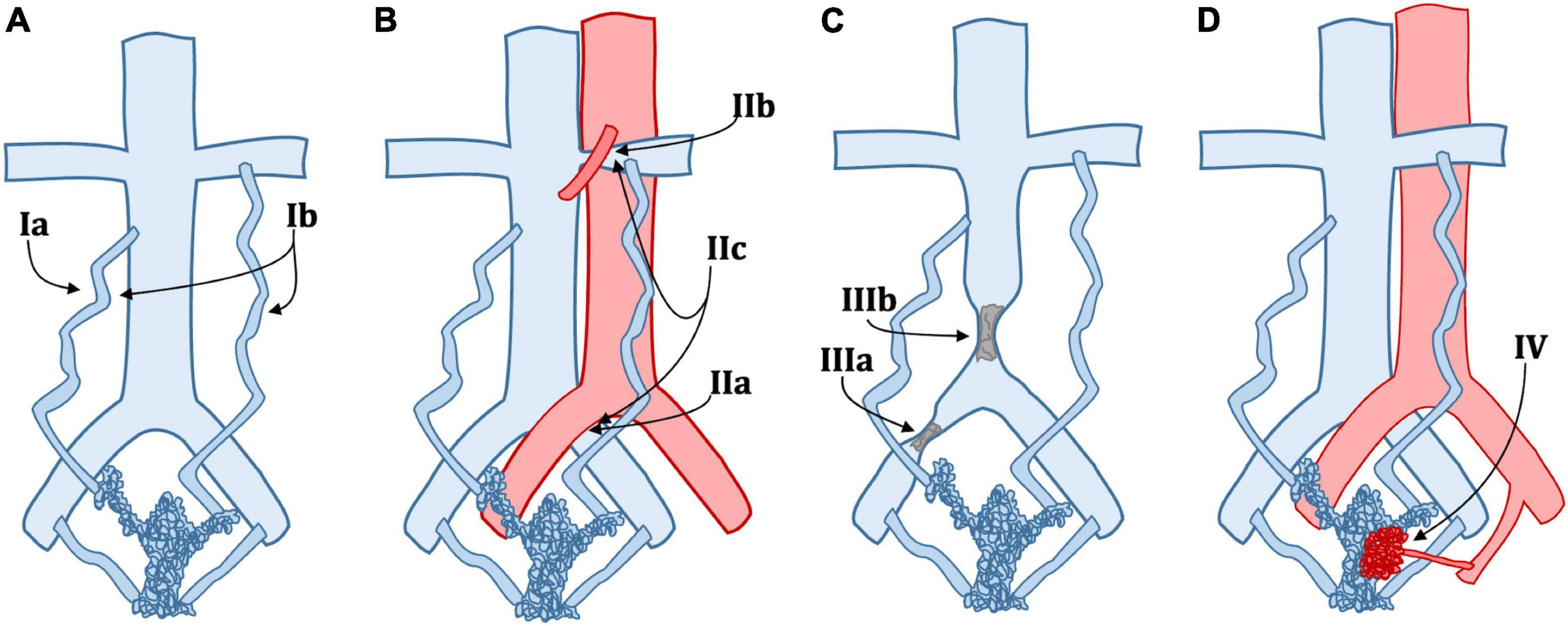 Insights into pelvic venous disorders